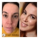 Complete fluid face lift and jawline definition