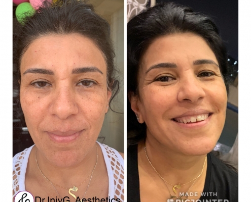 Fluid face lift and Mesotherapy