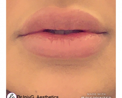 Natural lip augmentation